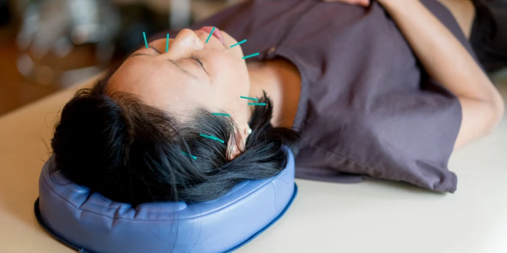 Who Are Acupuncturists and Why Connect With Them